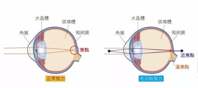 500度近視又老花，戴上美麗島多焦鏡煩惱全解決，46歲的周先生樂壞了
